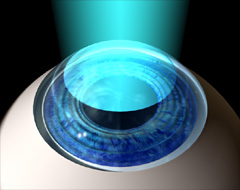 Laser reshapes
