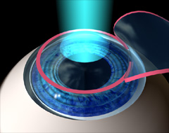 Laser reshaping