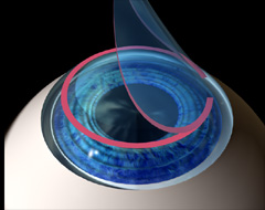 Corneal flap raised