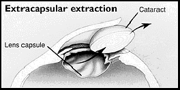 Schematic lens extraction