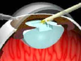 Phaco diagram