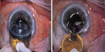 Lens extraction