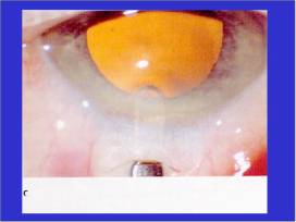 Phaco incision