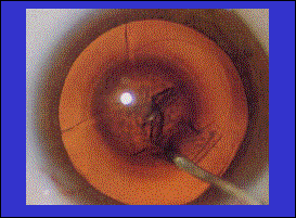 Phaco emulsification