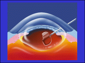 Phaco suction