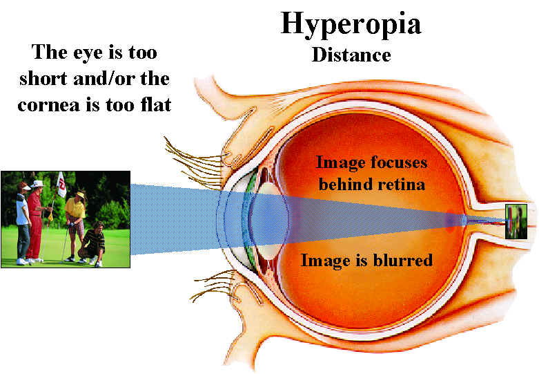 Hyperopic eye