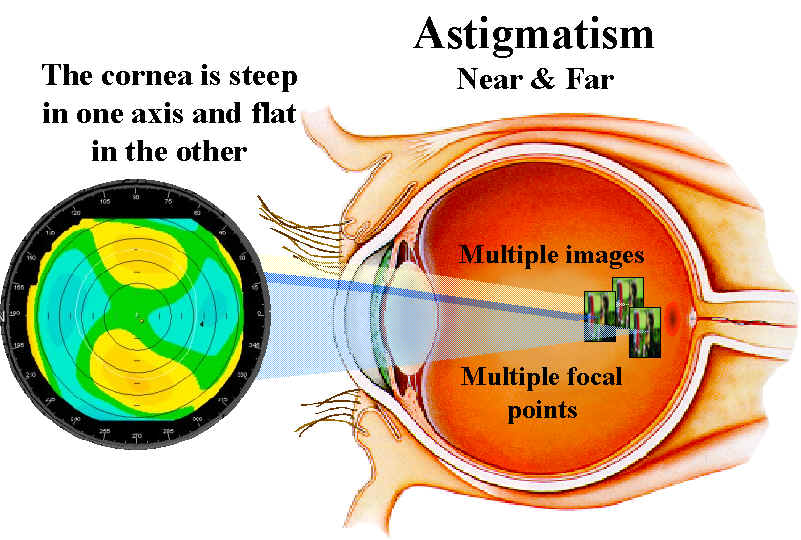 Astigmatic eye